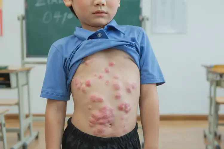 小學(xué)生肚子上經(jīng)常起濕疹可以徹底自愈嗎(圖4)