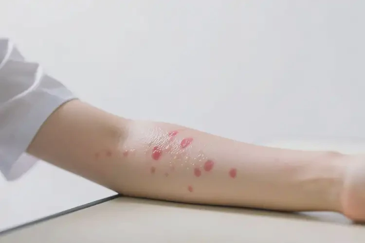 大學(xué)生手臂起濕疹能徹底自愈嗎(圖4)