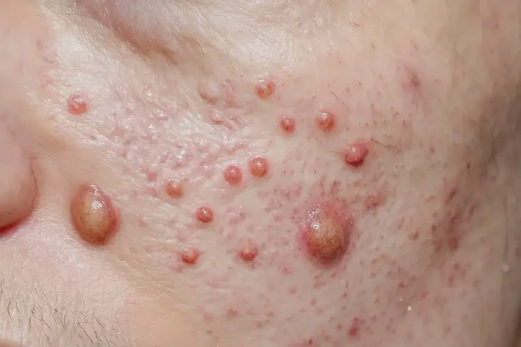 男人大腿上出现湿疹能不能根治(图4)