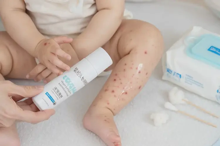 幼兒四肢偶爾長濕疹可不可以徹底自愈(圖3)