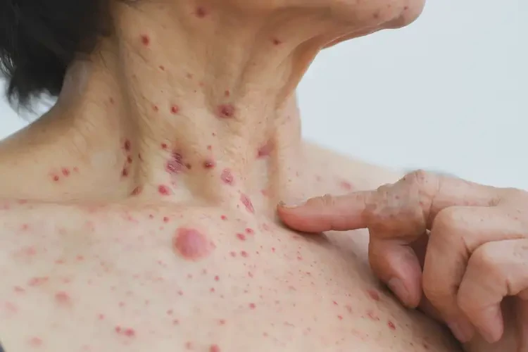 女人脖子容易起濕疹能不能根治(圖4)