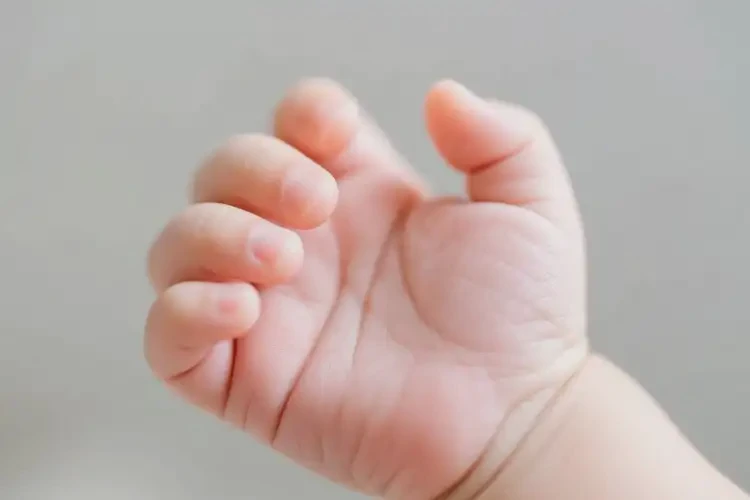 嬰兒手上起濕疹可不可以根治(圖3)