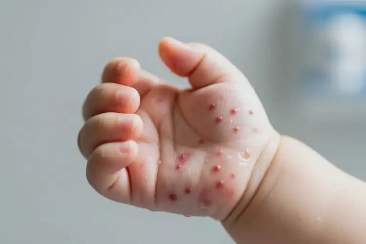 嬰幼兒手上容易長濕疹可不可以根治(圖2)