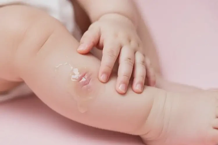 嬰兒小腿經(jīng)常長(zhǎng)濕疹可不可以根治(圖1)