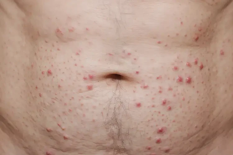 老年人肚子上長濕疹可不可以根治(圖4)