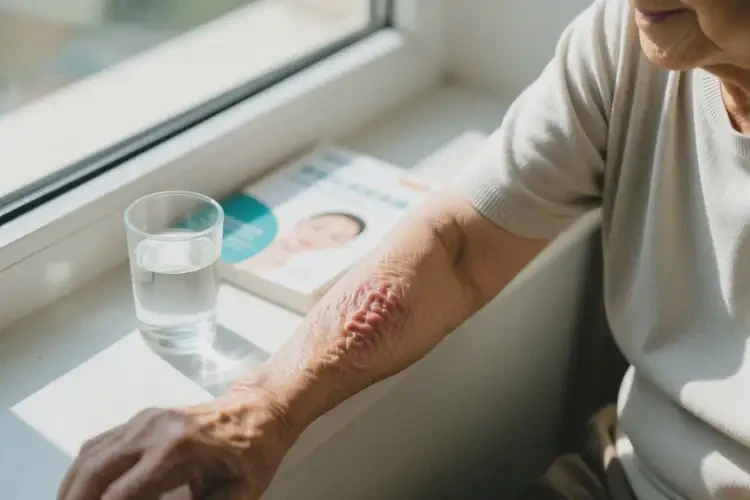 老年人手臂出濕疹可不可以根治(圖2)