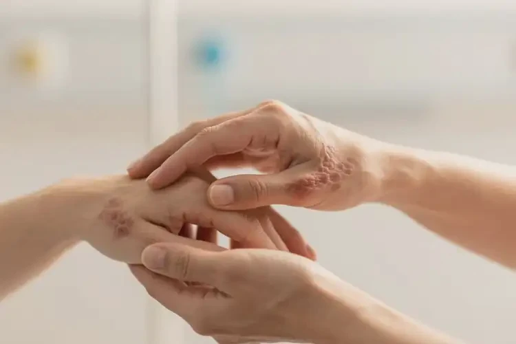 女人手上偶爾起濕疹能不能根治(圖2)