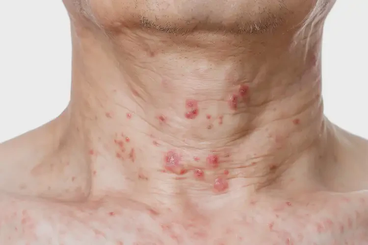 男人脖子容易長(zhǎng)濕疹能不能根治(圖4)