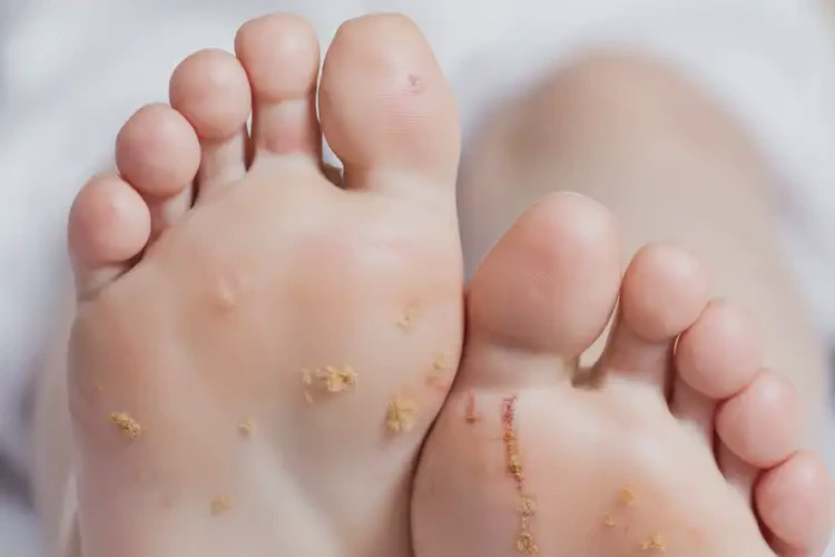 小兒腳上經(jīng)常長濕疹可不可以徹底自愈(圖4)