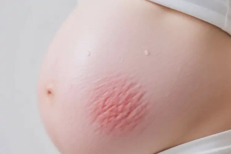 產(chǎn)婦肚子上長(zhǎng)濕疹可以徹底自愈嗎(圖2)