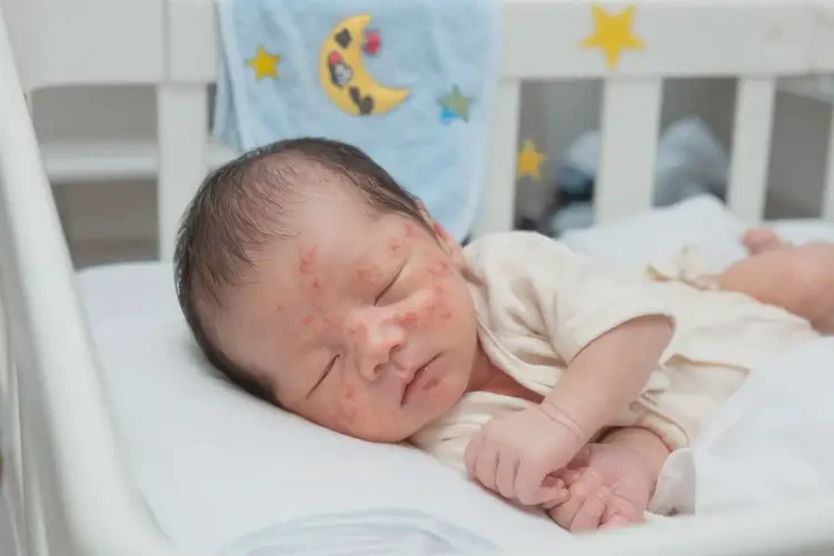 新生儿肚子上有湿疹可不可以根治(图4)