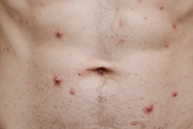 男人肚子上長濕疹能不能根治(圖4)