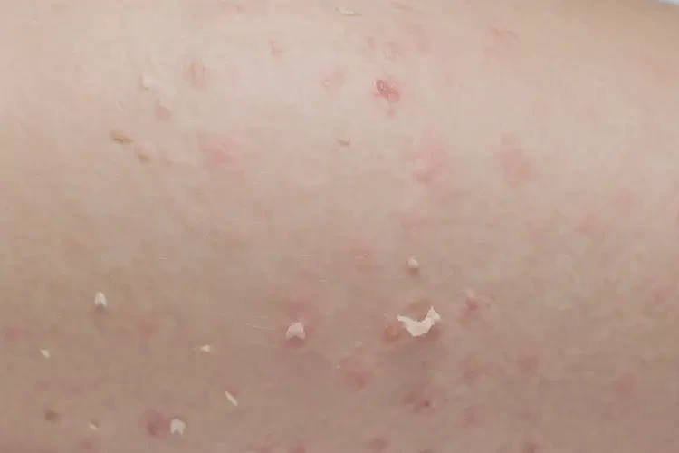 少兒大腿容易長(zhǎng)濕疹能靠自己自愈嗎(圖4)