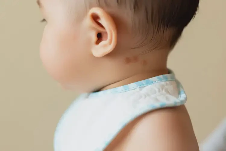 嬰幼兒脖子上出濕疹可不可以根治(圖2)