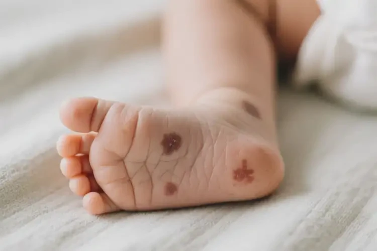 嬰兒腳上偶爾長(zhǎng)濕疹能靠自己自愈嗎(圖1)