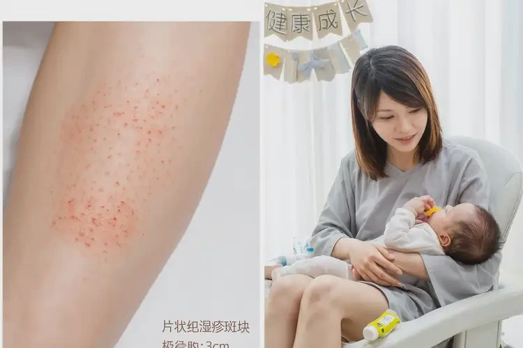哺乳期媽媽小腿經常長濕疹能不能根治(圖4)