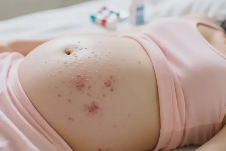 孕婦肚子上容易長濕疹可不可以根治(圖2)