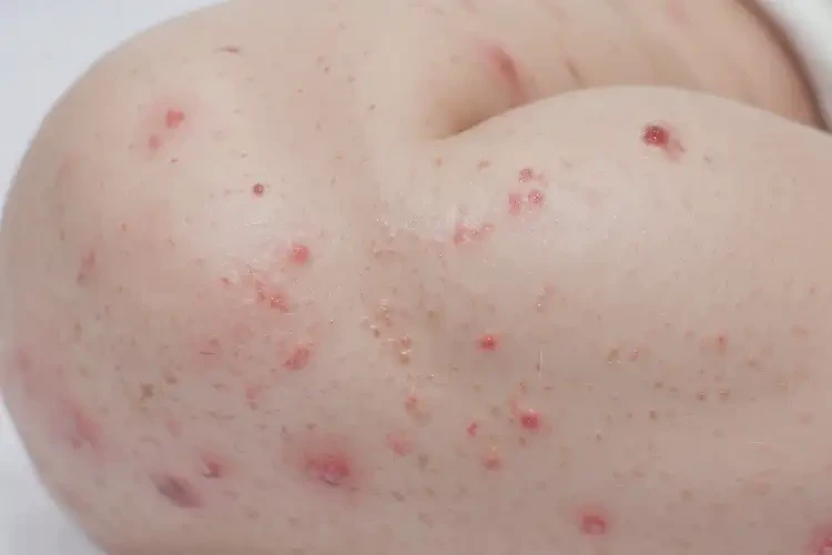 嬰幼兒大腿長濕疹不管它會自己痊愈嗎(圖4)