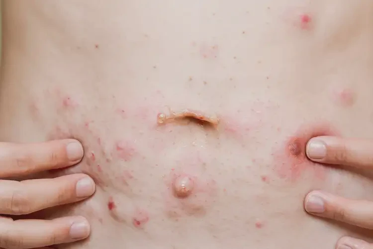 青少年肚子上起濕疹可不可以根治(圖4)