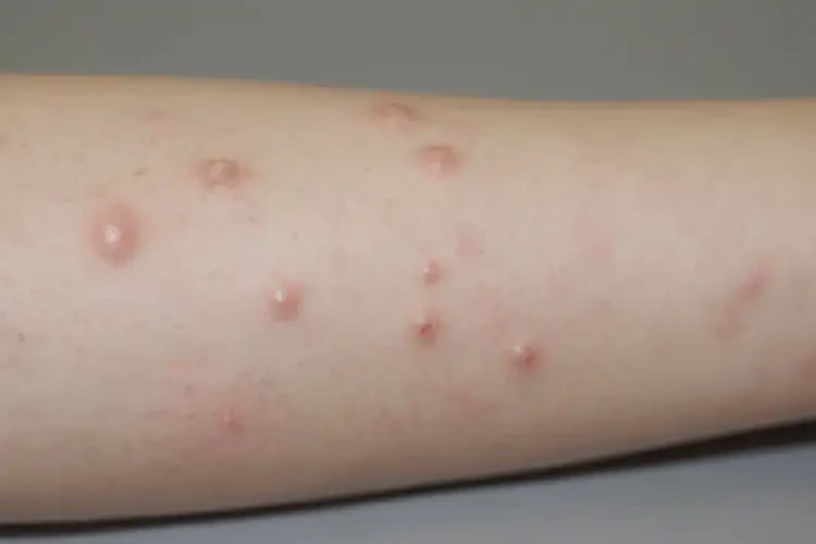 女生手臂上有濕疹可以徹底自愈嗎(圖4)