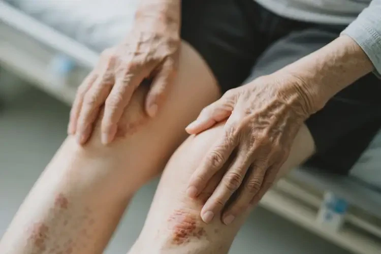 高齡老人四肢經(jīng)常起濕疹能不能根治(圖2)