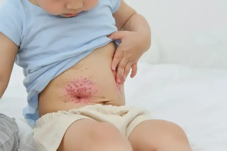 小孩肚子長濕疹能靠自己自愈嗎(圖2)