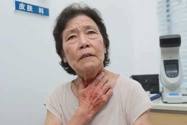 老人脖子上偶尔起湿疹可不可以根治(图4)