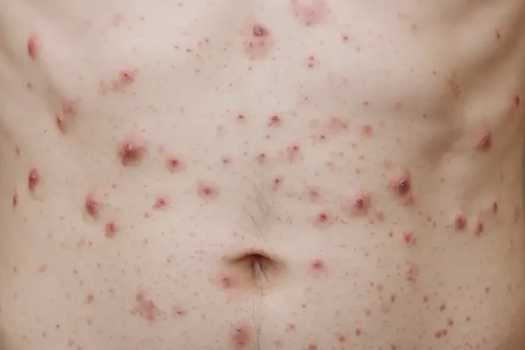 青少年肚子經(jīng)常起濕疹可不可以根治(圖4)