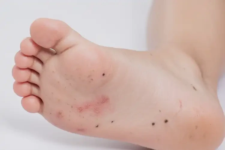 孩子腳上偶爾起濕疹不管它會自己自愈嗎(圖4)