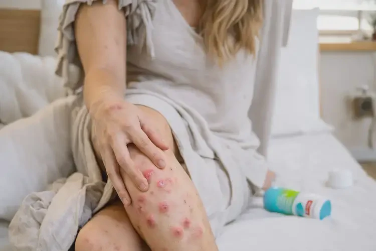 哺乳期媽媽小腿上長濕疹能不能根治(圖4)