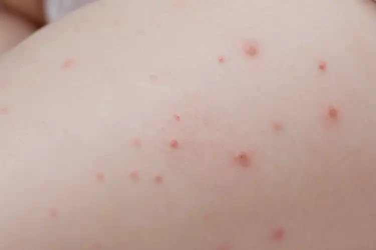 寶寶大腿上長濕疹不管它會自己自愈嗎(圖4)