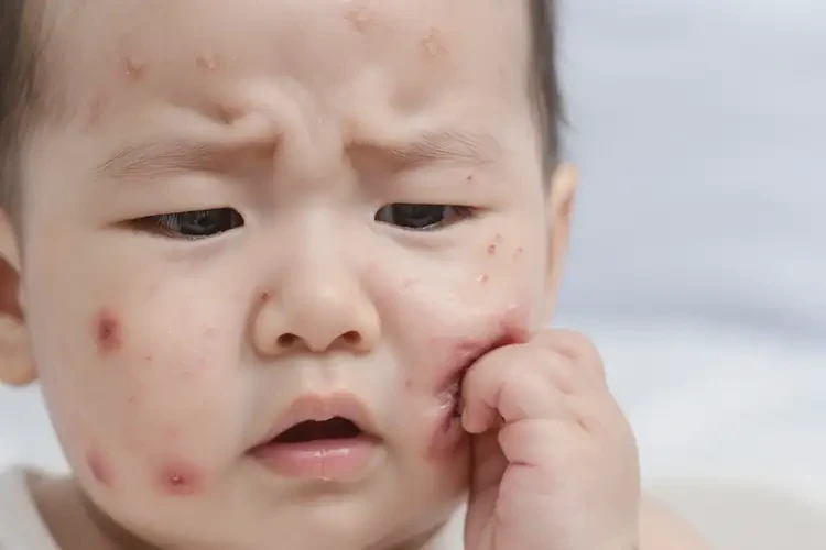 宝宝全身容易长湿疹不管它会自己痊愈吗(图4)
