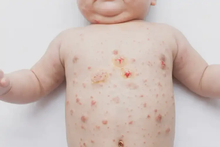 嬰幼兒肚子上偶爾長(zhǎng)濕疹能靠自己自愈嗎(圖2)