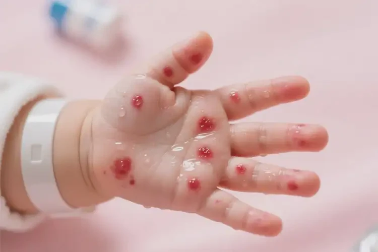 嬰幼兒手上容易長濕疹可不可以根治(圖3)