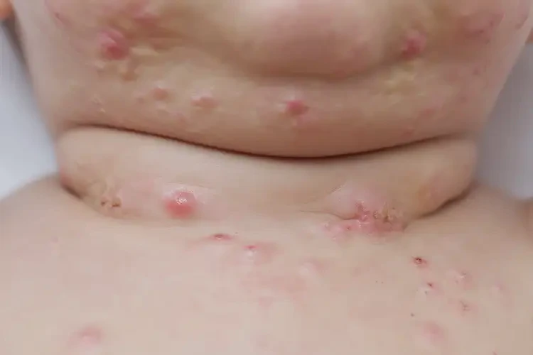 寶寶脖子上容易長濕疹不管它會自己痊愈嗎(圖3)