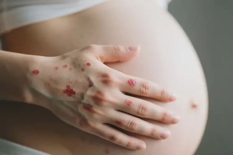 孕婦手上出現(xiàn)濕疹可不可以根治(圖3)