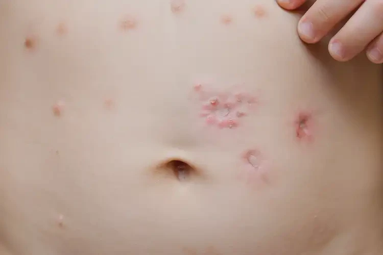 少兒肚子容易起濕疹能靠自己自愈嗎(圖4)
