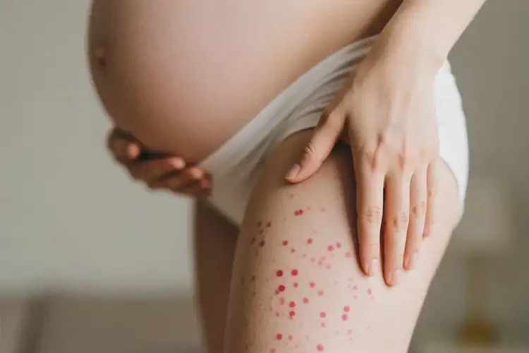 產(chǎn)婦小腿上偶爾起濕疹能徹底自愈嗎(圖1)