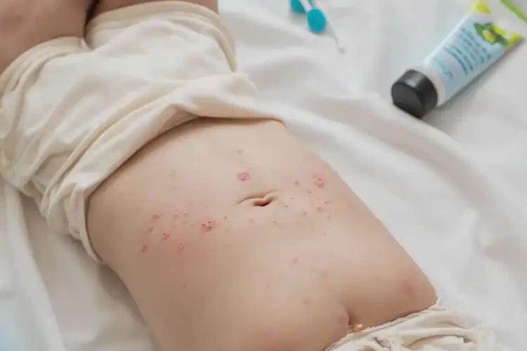 嬰幼兒肚子偶爾長(zhǎng)濕疹不管它會(huì)自己自愈嗎(圖4)