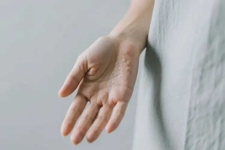 女人手上有濕疹能不能根治(圖1)