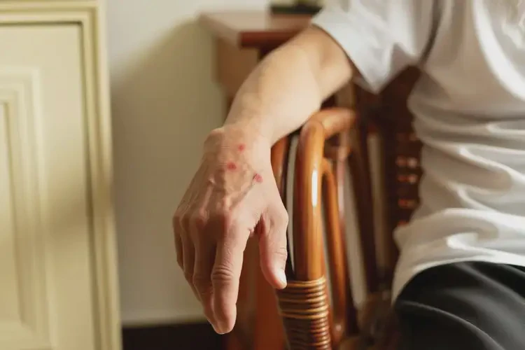 老人身上容易起濕疹不管它會自己自愈嗎(圖4)