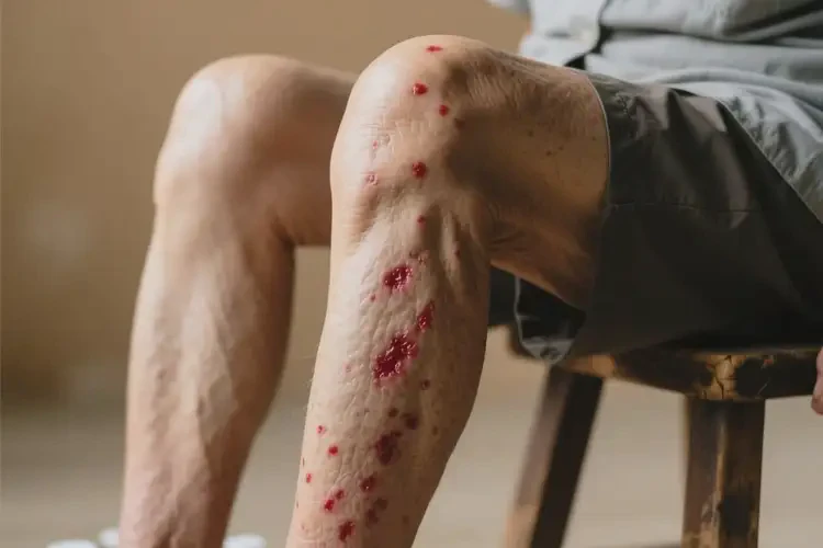 老人大腿上經(jīng)常長(zhǎng)濕疹可不可以根治(圖1)