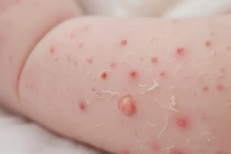 新生兒全身偶爾長濕疹能徹底自愈嗎(圖4)