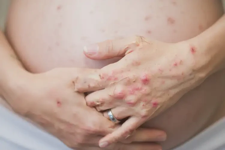 孕婦四肢經(jīng)常起濕疹不管它會自己自愈嗎(圖4)