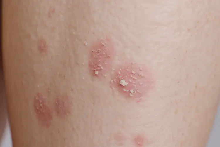 女人小腿上經(jīng)常長濕疹能不能根治(圖4)