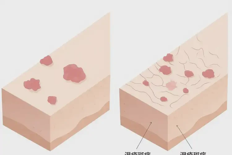 兒童小腿上容易起濕疹可不可以根治(圖4)