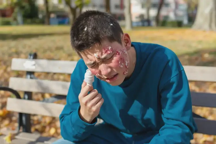 大學(xué)生臉上有濕疹可不可以徹底自愈(圖4)