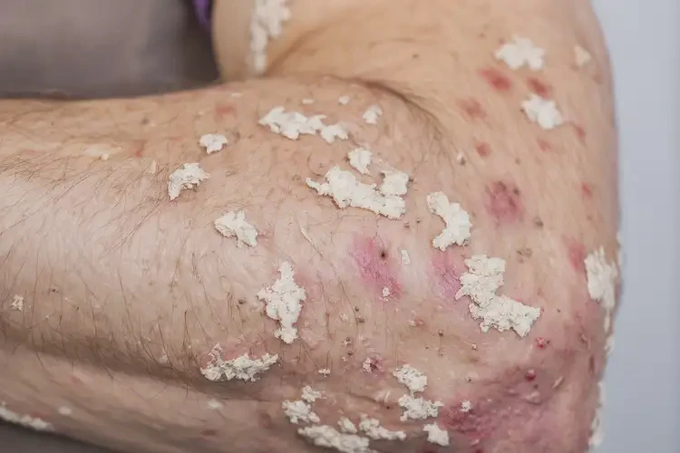 男人手臂出现湿疹不管它会自己好吗(图3)