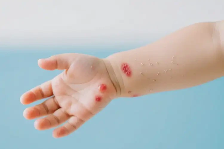 幼兒手臂上起濕疹能徹底自愈嗎(圖2)