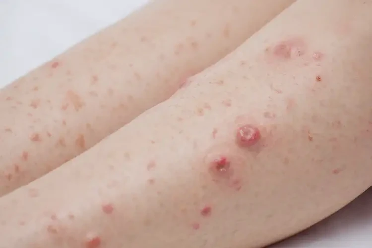 孕婦小腿出濕疹可不可以根治(圖4)